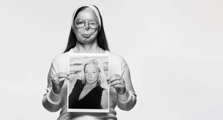 Γυναίκα θύμα επίθεσης με οξύ κρατά φωτογραφίας της όπως ήταν παλιά