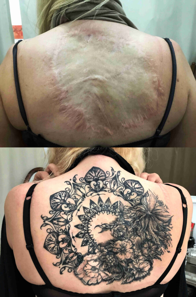 iatriko-tatouaz-apokatastasis-otan-i-dermatostixia-svinei-ta-simadia-pou-ponane-pridegr