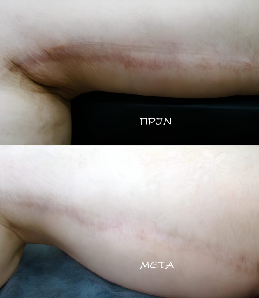 iatriko-tatouaz-apokatastasis-otan-i-dermatostixia-svinei-ta-simadia-pou-ponane-pridegr 
